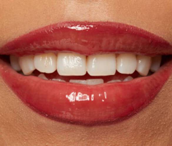 Lachelnde Lippen mit rotem Lipgloss und weißen Zahnen, im Fokus auf den Mundbereich.